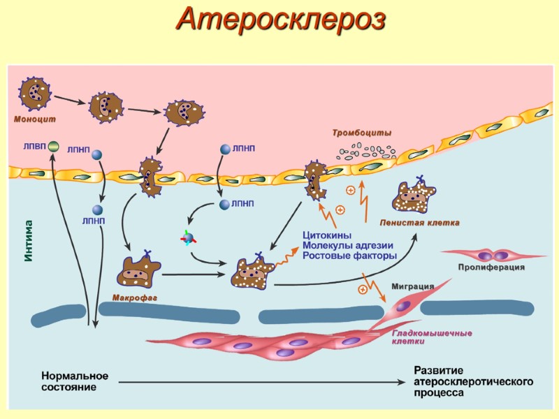 Атеросклероз